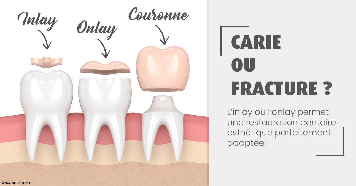 https://selarl-sandrine-dussert.chirurgiens-dentistes.fr/T2 2023 - Carie ou fracture 1