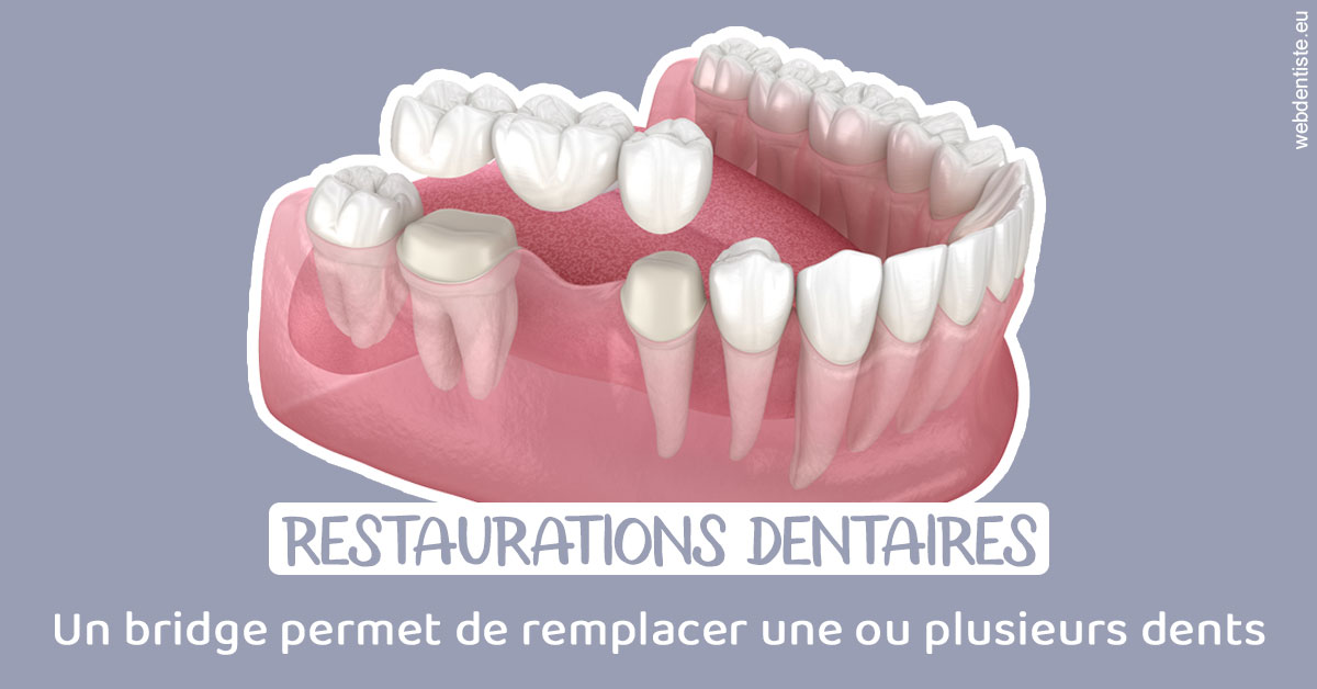 https://selarl-sandrine-dussert.chirurgiens-dentistes.fr/Bridge remplacer dents 1