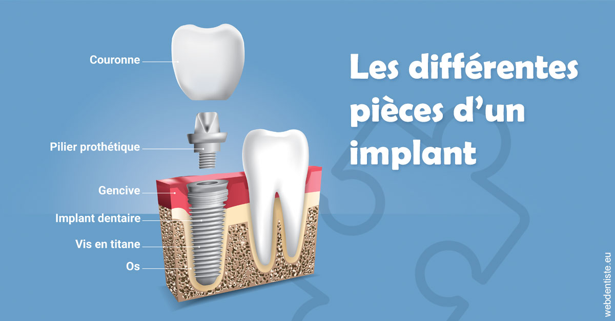 https://selarl-sandrine-dussert.chirurgiens-dentistes.fr/Les différentes pièces d’un implant 1